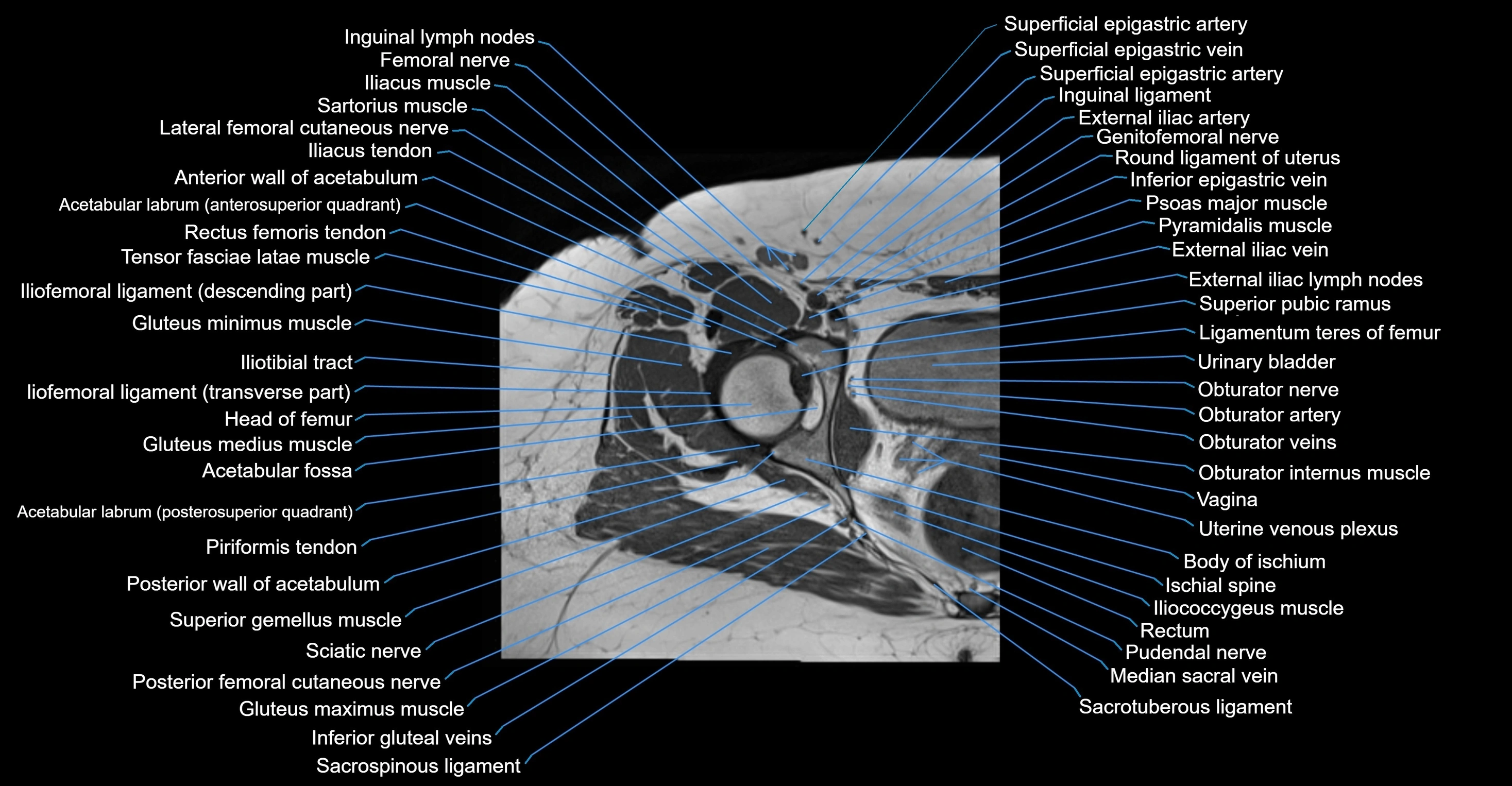 MRI hip axial cross sectional anatomy 3T 3D  radiology  anatomy image-img-00001-00033.webp